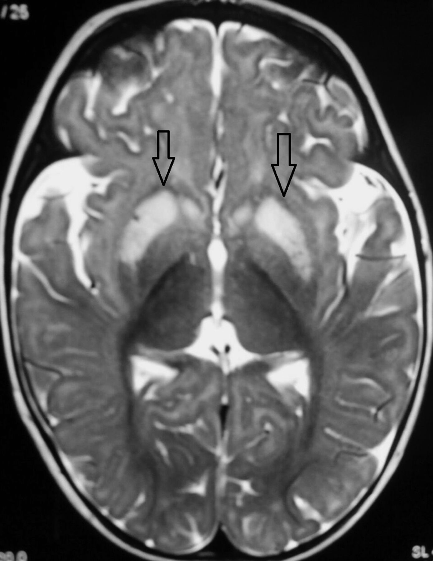infantile-wernicke-s-encephalopathy-archives-of-disease-in-childhood