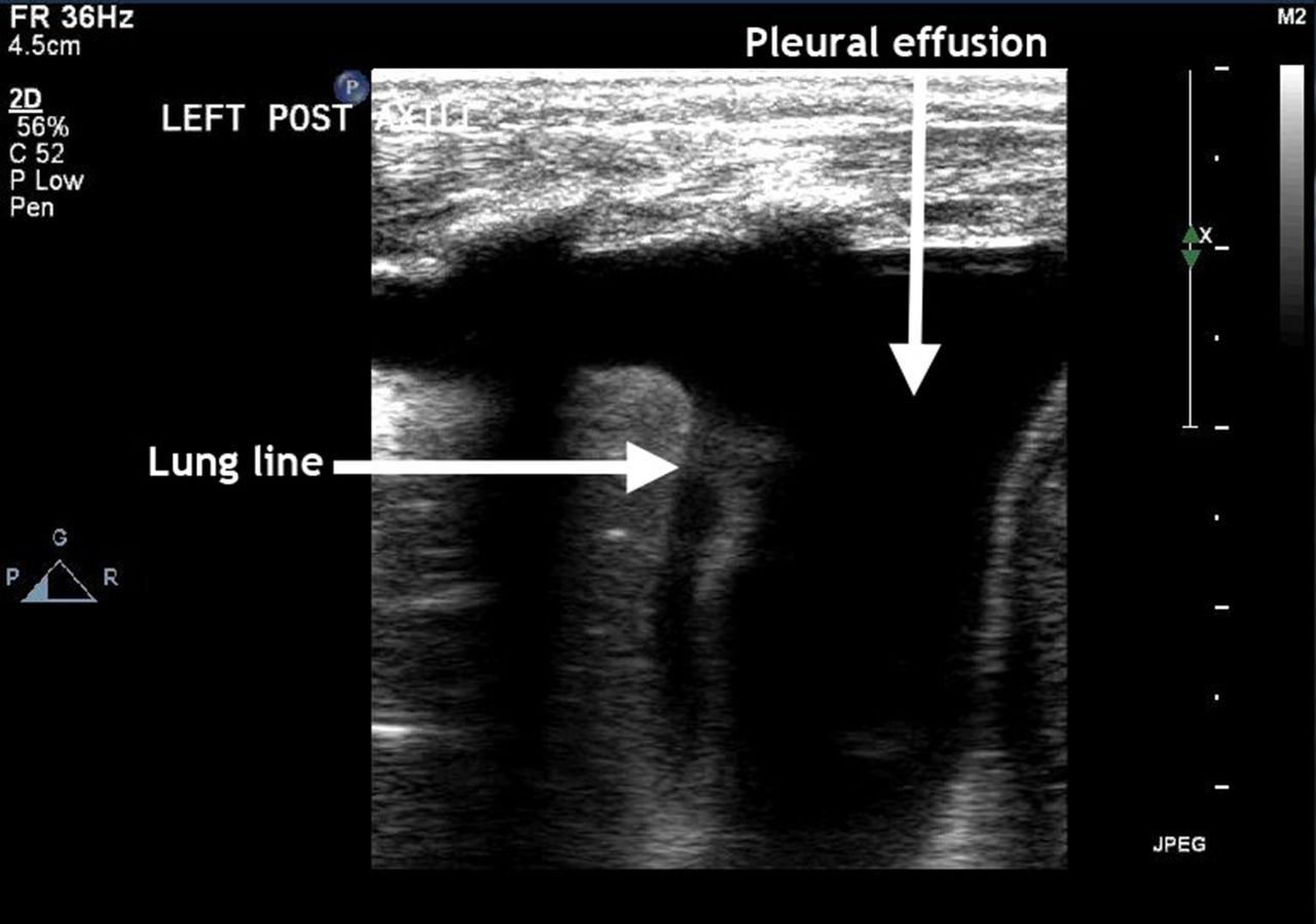 Utility of lung ultrasound scanning in neonatology | Archives of ...